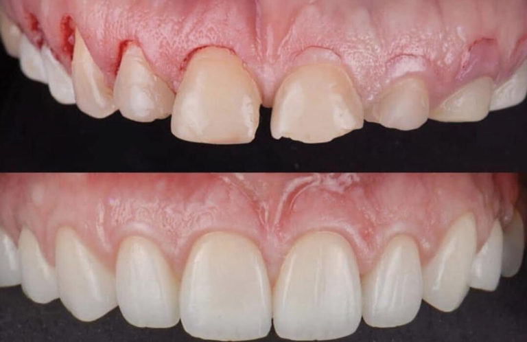 Smile design – A brief overview