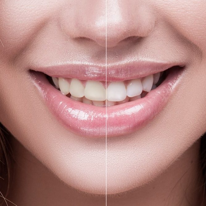 Free Laser Teeth Whitening with Your Exam and Cleaning