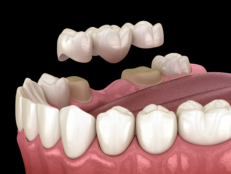 Dental Bridges