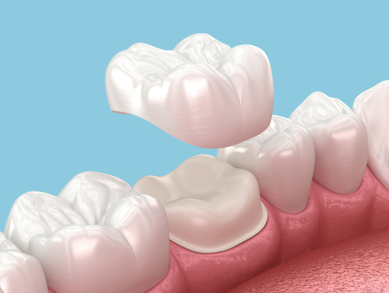 Dental Crowns