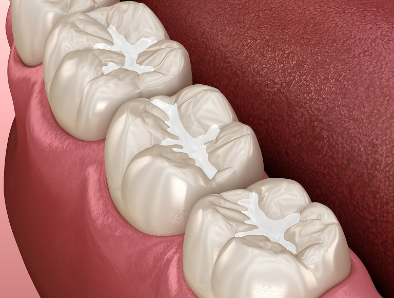 Dental Sealants